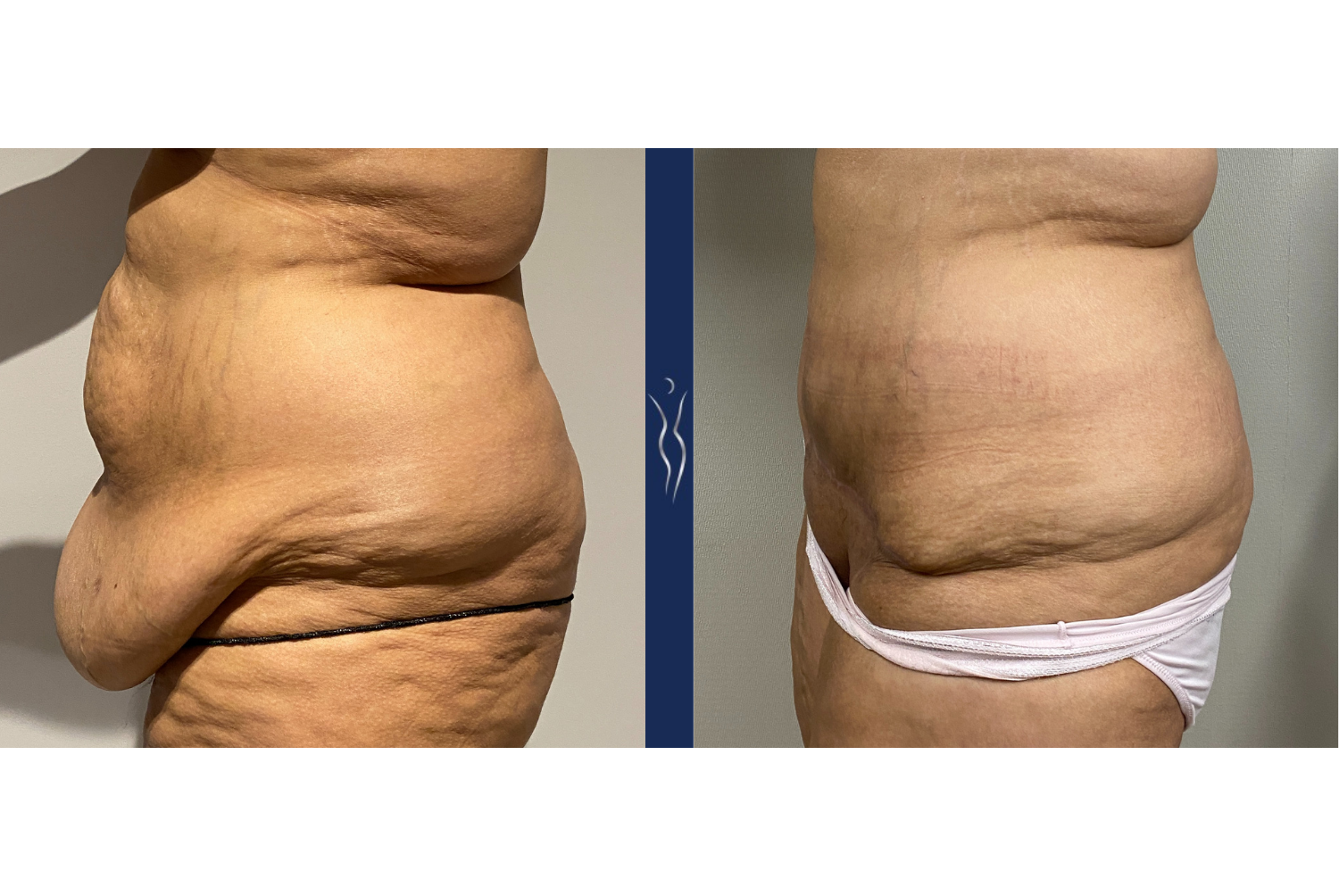 Fleur De Lis Tummy Tuck: Transforming Loose Skin After Massive Weight Loss