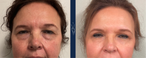 59 year old lady fat transfer to face, upper blepharoplasty, 4 months front NW﹖width=1740&name=59 year old lady fat transfer to face, upper blepharoplasty, 4 months front NW