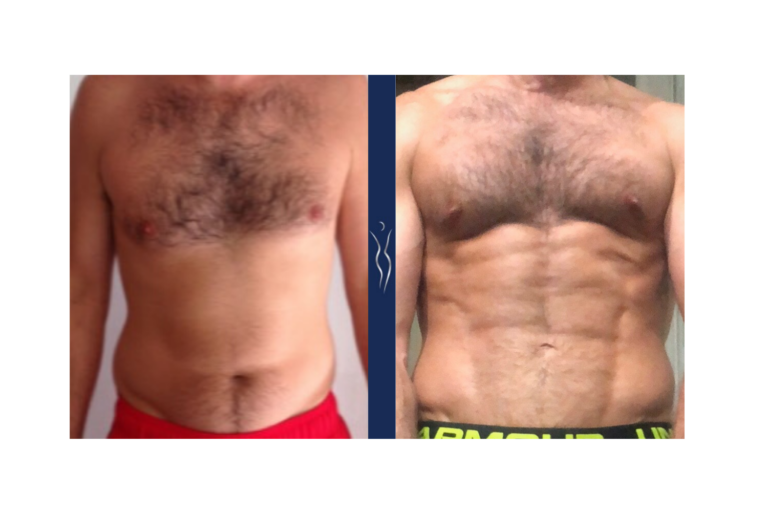 35 year old caucasian man high definition VASER core liposuction