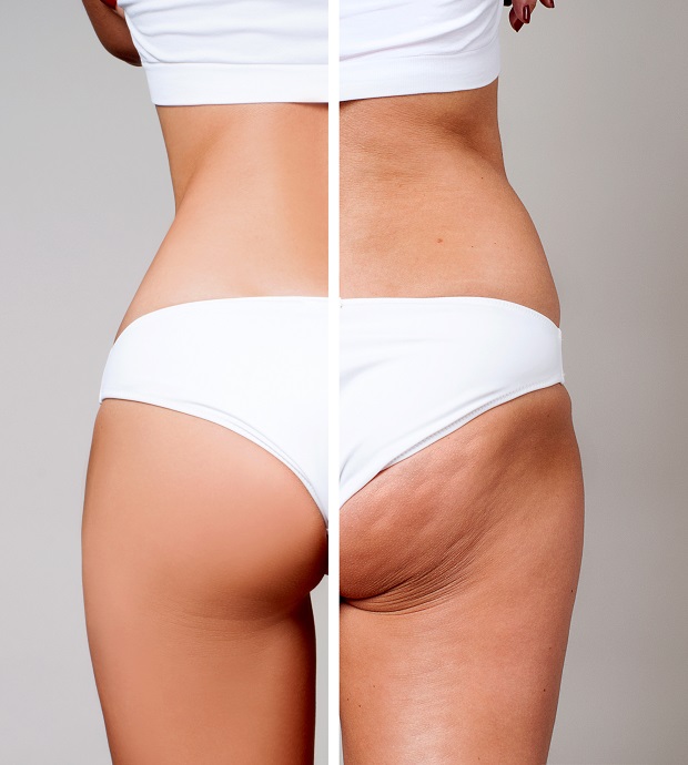 Aveli Cellulite Treatment Nashville