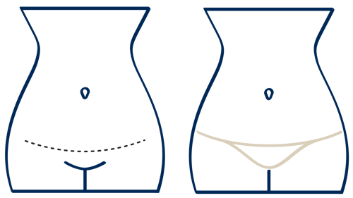 isa standard scar tuck illustration 032423