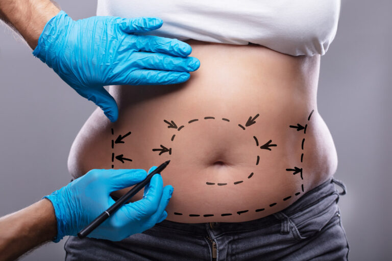 liposuction prep