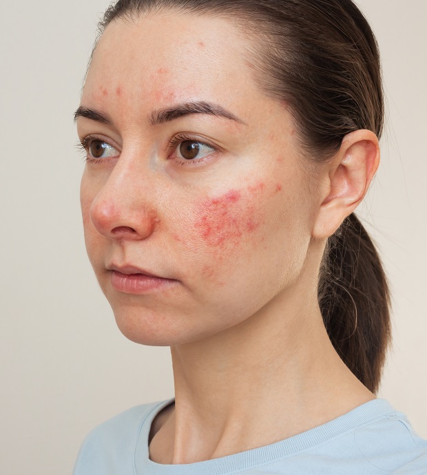 Young,Caucasian,Woman,Suffering,From,Rosacea,On,Her,Face,In