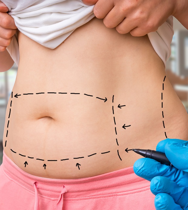 Tummy Tuck Nashville