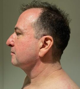 After Image: Neck Liposuction with Skin Tightening (Renuvion)