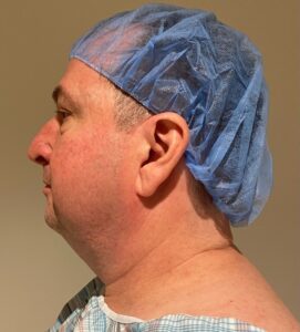 Before Image: Neck Liposuction with Skin Tightening (Renuvion)