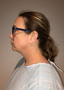 Before Image: Neck Liposuction with Skin Tightening (Renuvion)