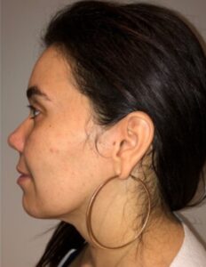 After Image: Neck Liposuction with Skin Tightening (Renuvion)