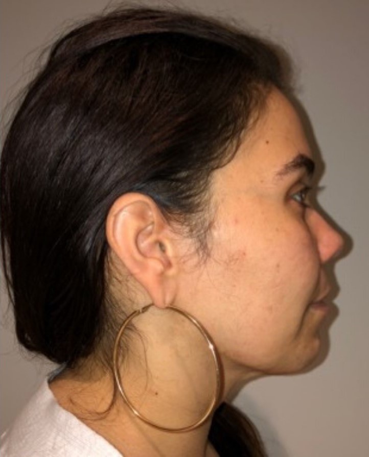 After Image: Neck Liposuction with Skin Tightening (Renuvion) - right-side