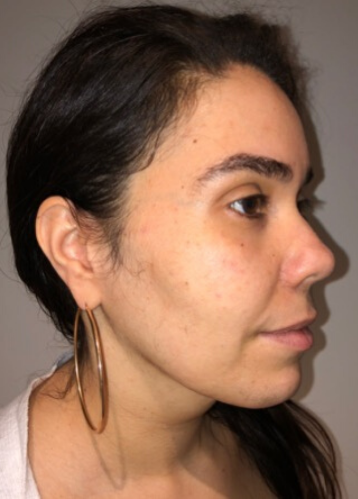 After Image: Neck Liposuction with Skin Tightening (Renuvion) - right-front-oblique