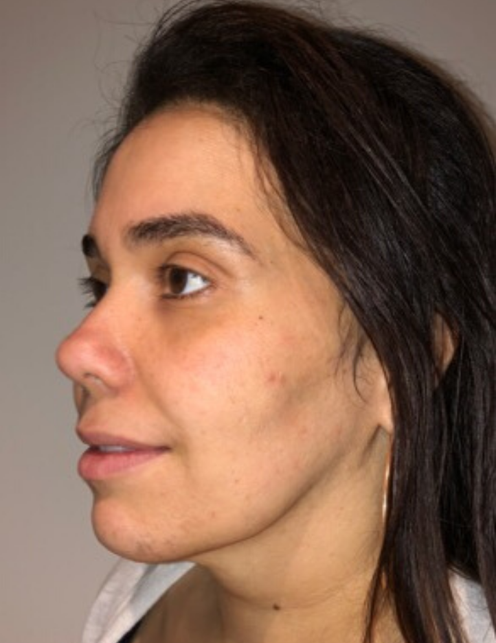 After Image: Neck Liposuction with Skin Tightening (Renuvion) - left-front-oblique