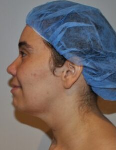 Before Image: Neck Liposuction with Skin Tightening (Renuvion)