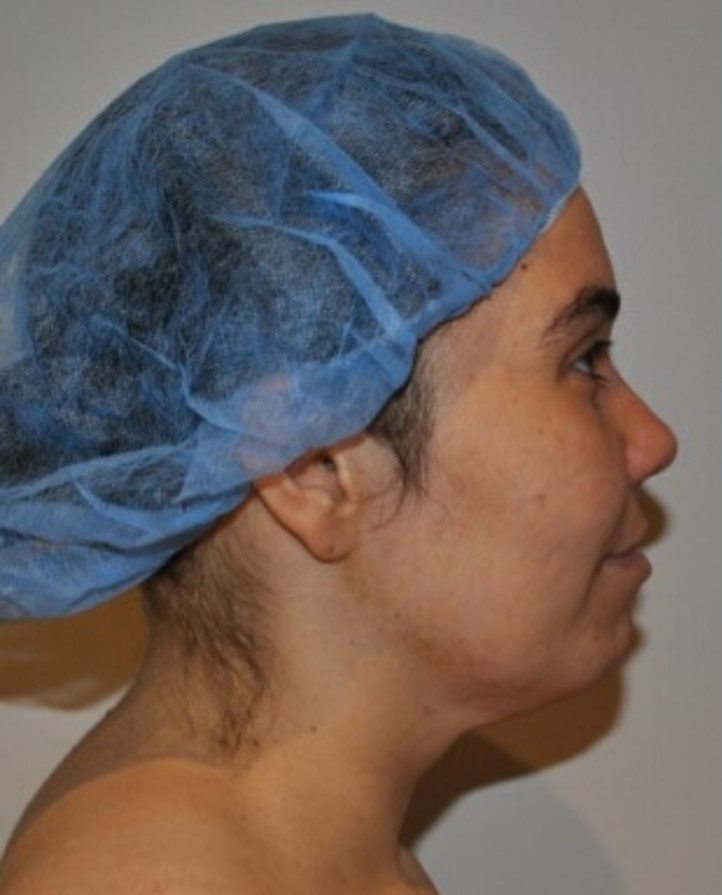 Before Image: Neck Liposuction with Skin Tightening (Renuvion) - right-side