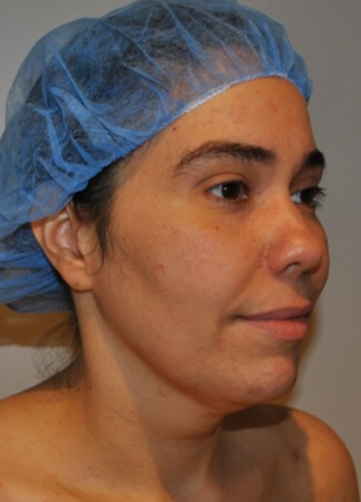 Before Image: Neck Liposuction with Skin Tightening (Renuvion) - right-front-oblique