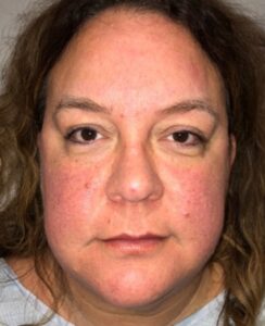 Before Image: Blepharoplasty