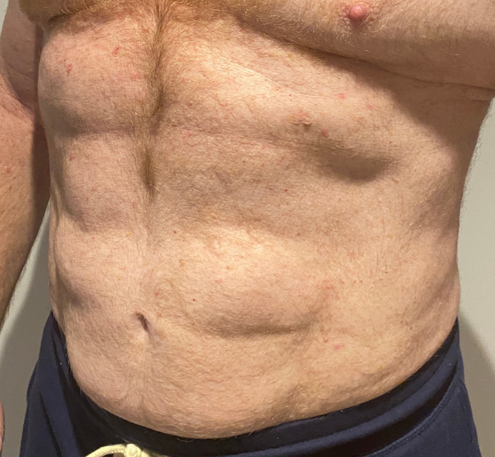 After Image: High Definition Liposuction - left-front-oblique