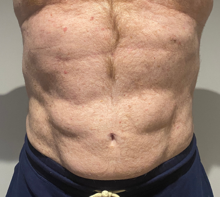 After Image: High Definition Liposuction - front