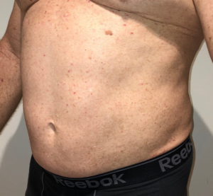 Before Image: High Definition Liposuction