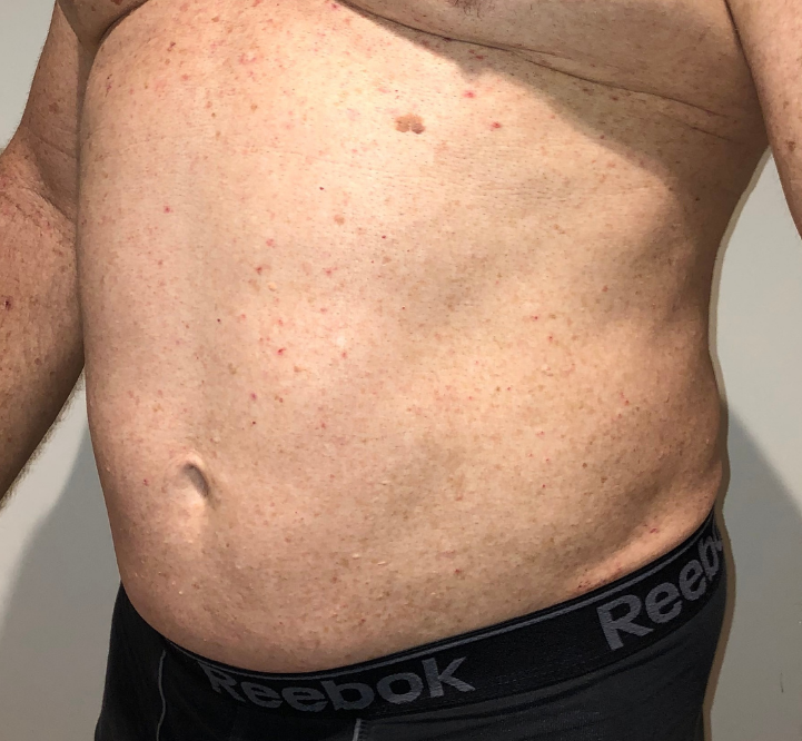 Before Image: High Definition Liposuction - left-front-oblique