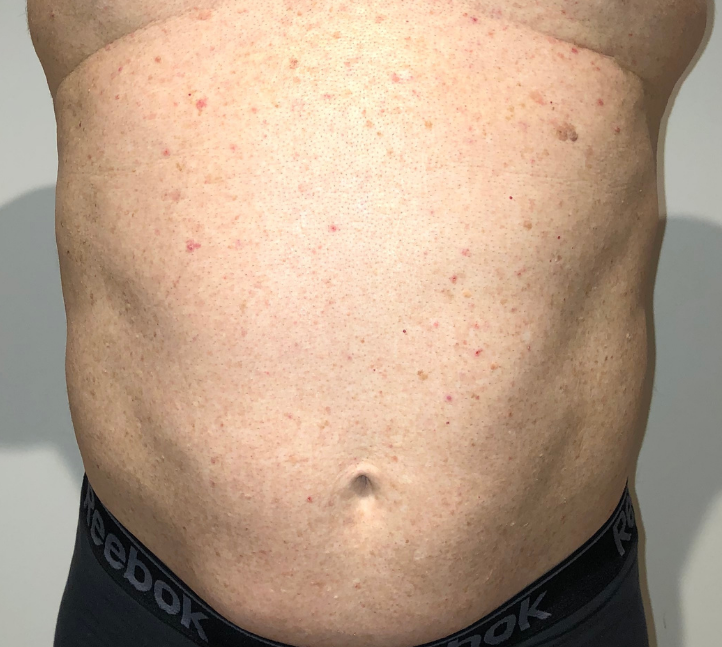 Before Image: High Definition Liposuction - front