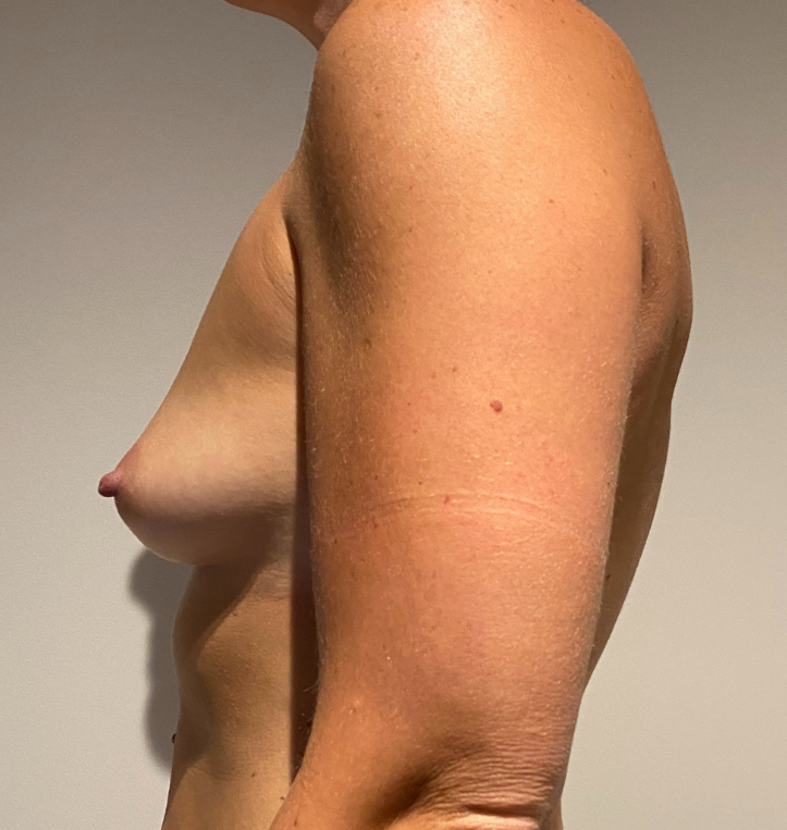 Before Image: Breast Augmentation - left-side