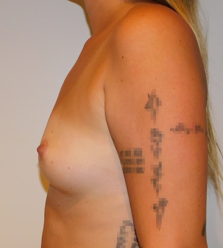 Before Image: Breast Augmentation - left-side