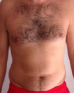 Before Image: High Definition Liposuction