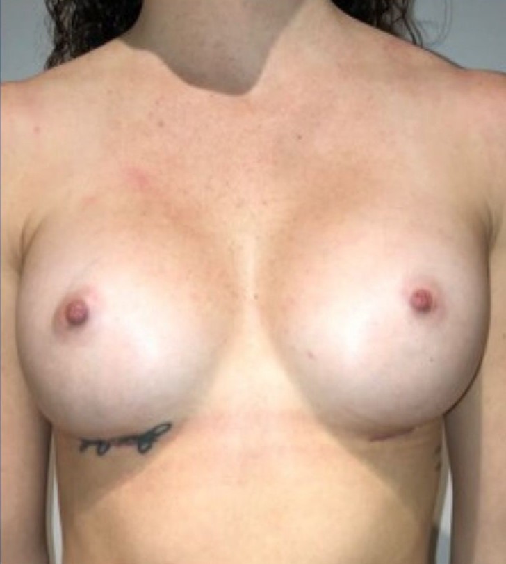 After Image: Breast Augmentation - front