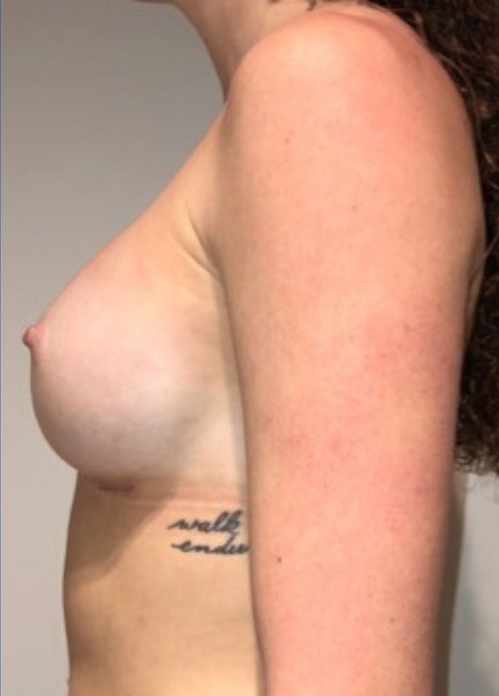 After Image: Breast Augmentation - left-side