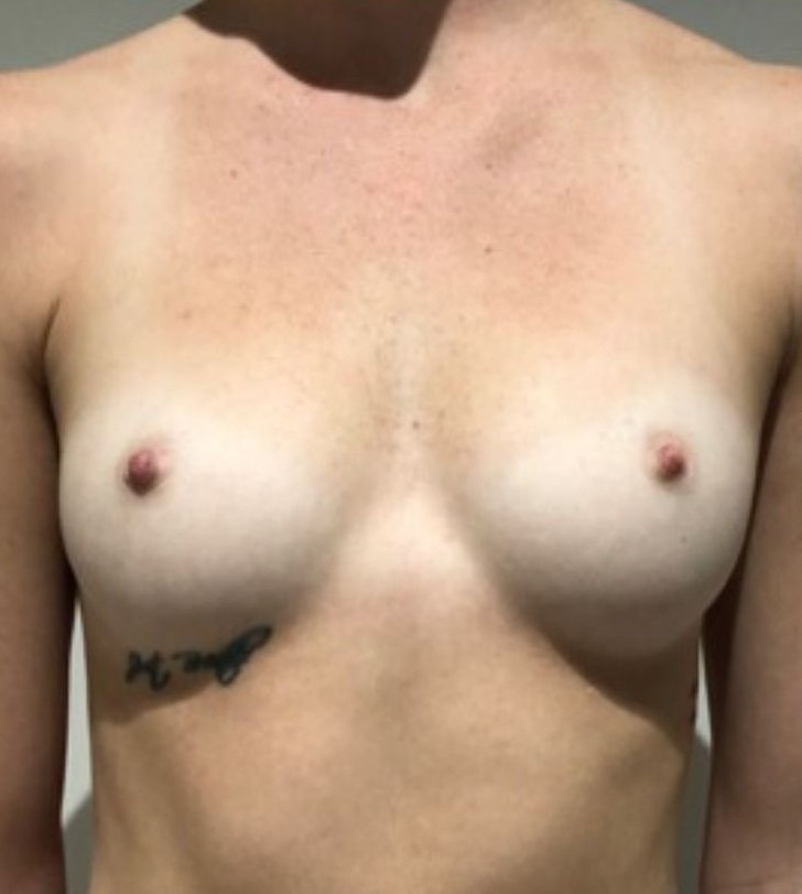 Before Image: Breast Augmentation - front