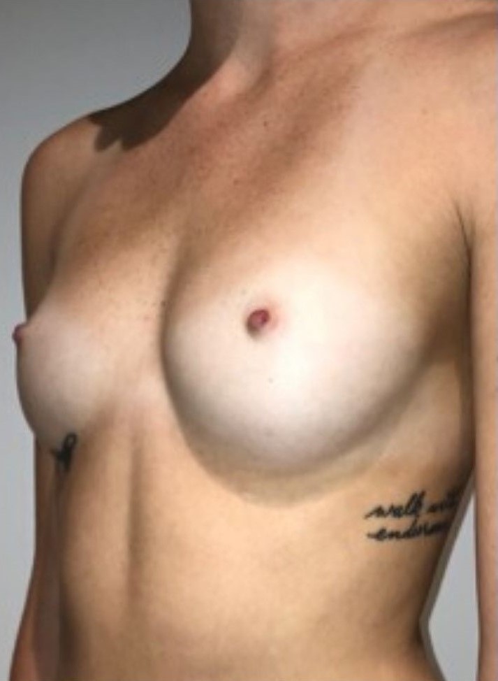 Before Image: Breast Augmentation - left-front-oblique