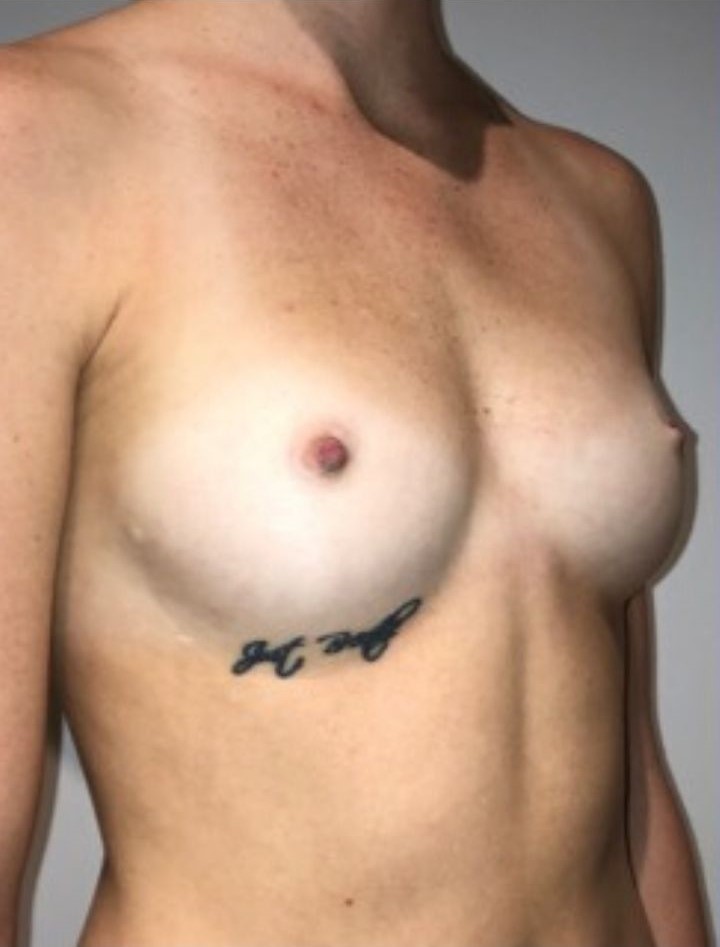 Before Image: Breast Augmentation - right-front-oblique