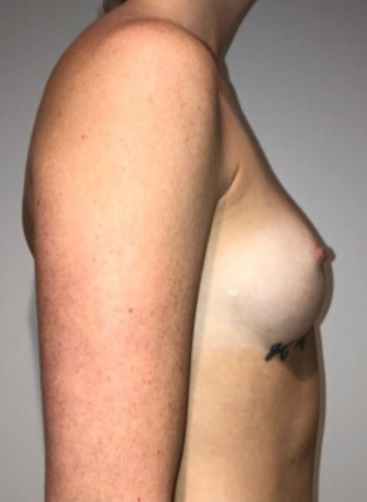 Before Image: Breast Augmentation - right-side