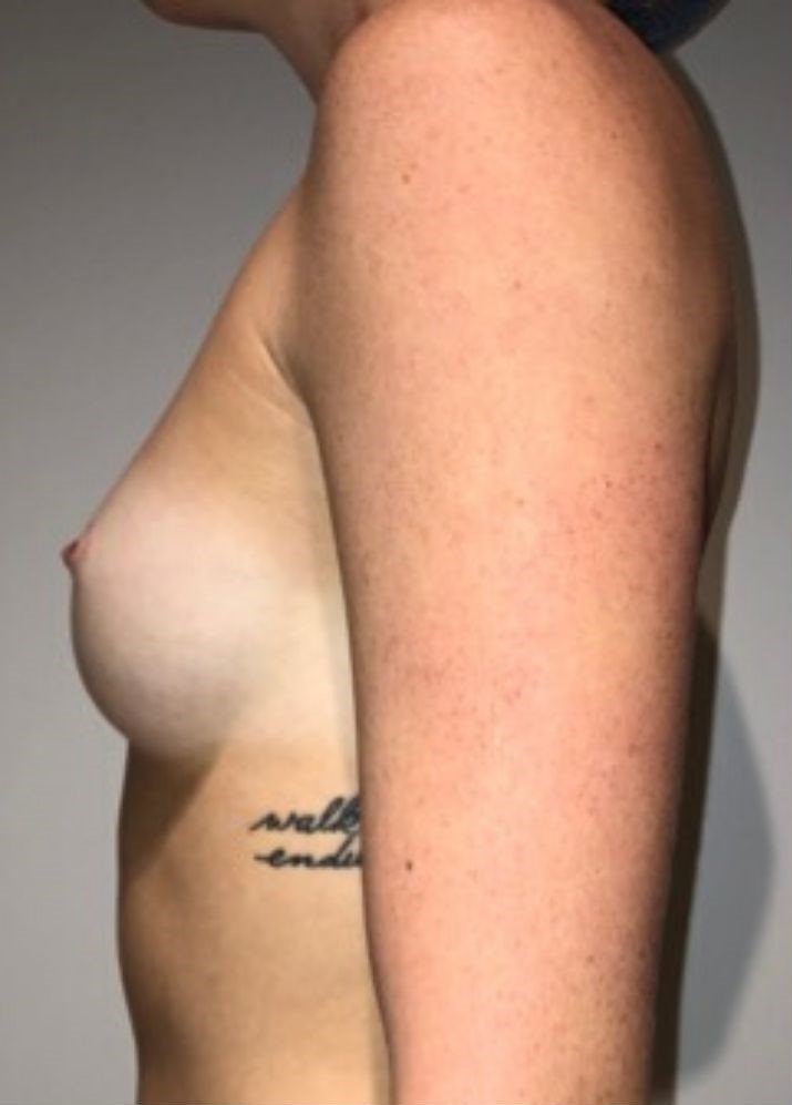 Before Image: Breast Augmentation - left-side