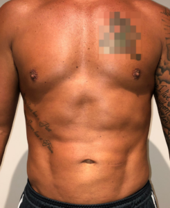 After Image: High Definition Liposuction