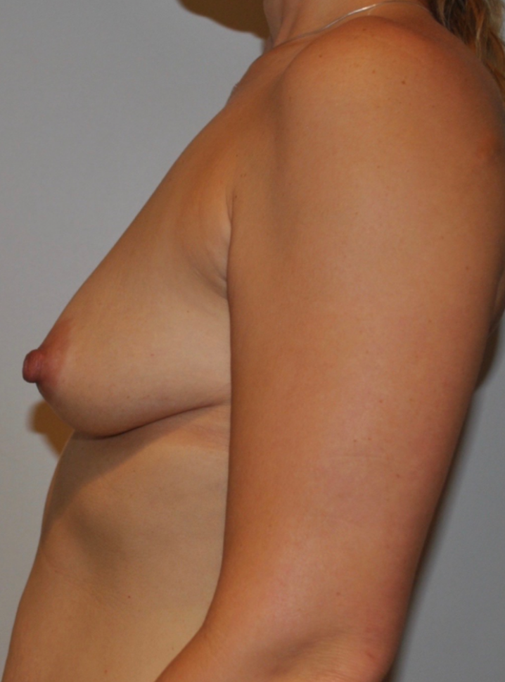 Before Image: Breast Augmentation - left-side