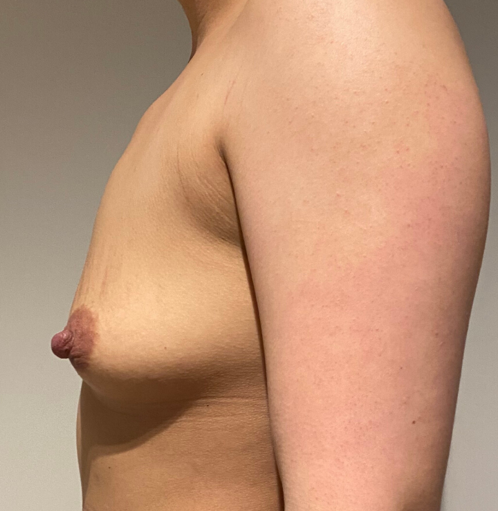 Before Image: Breast Augmentation - left-side