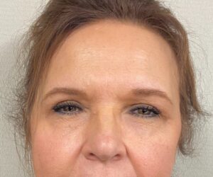 After Image: Blepharoplasty