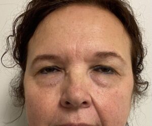 Before Image: Blepharoplasty