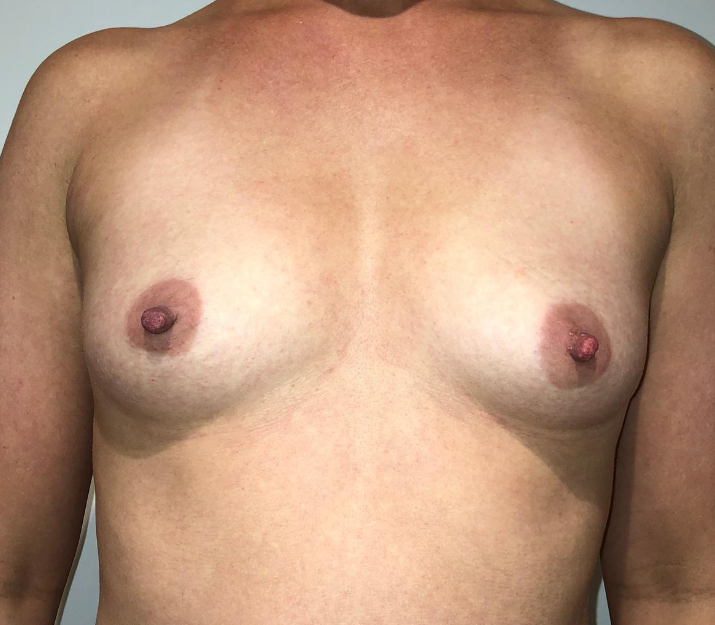 Before Image: Breast Augmentation - front