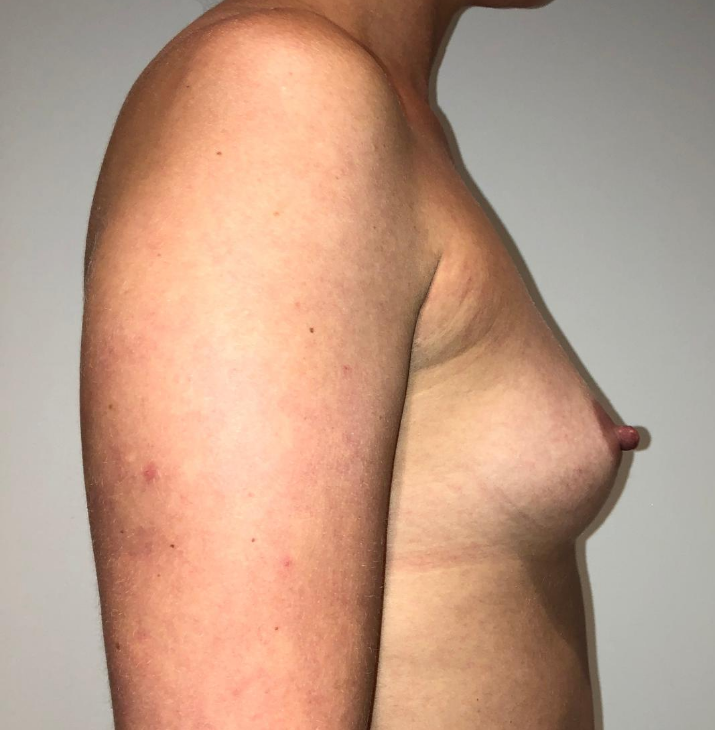 Before Image: Breast Augmentation - right-side