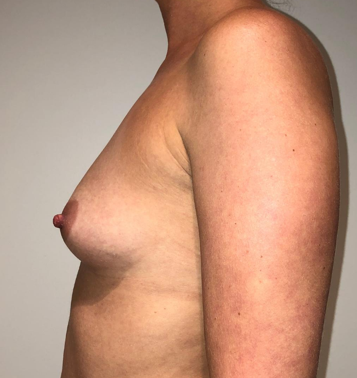 Before Image: Breast Augmentation - left-side