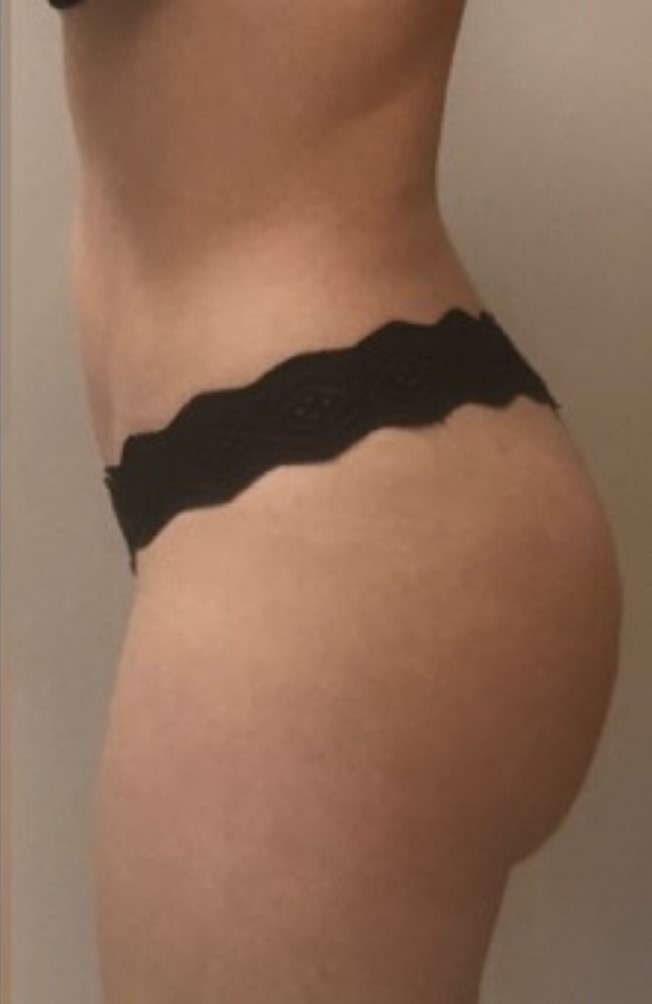 After Image: Brazilian Buttock Lift - left-side