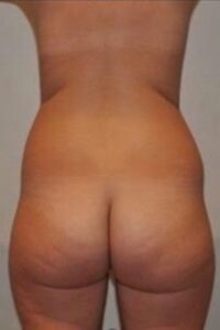 Before Image: Brazilian Buttock Lift