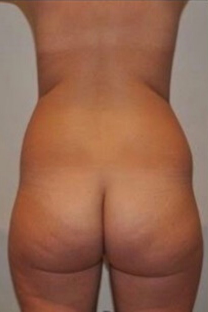 Before Image: Brazilian Buttock Lift - back