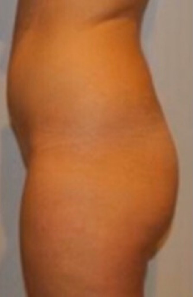 Before Image: Brazilian Buttock Lift - left-side