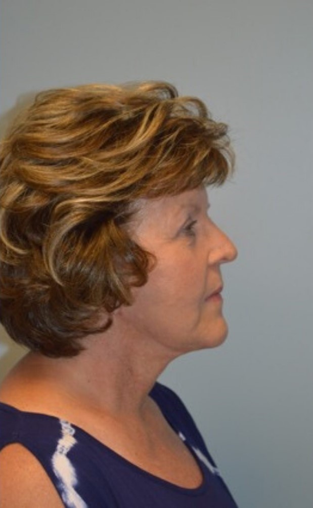 After Image: Facelift and Neck Lift - right-side