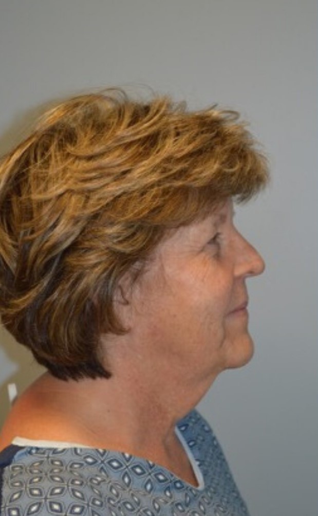 Before Image: Facelift and Neck Lift - right-side