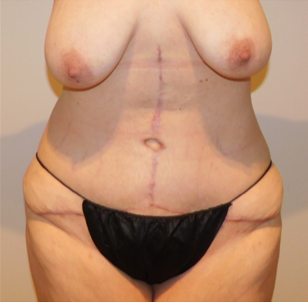 After Image: Post-Massive Weight Loss Surgery - front