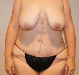 After Image: Post-Massive Weight Loss Surgery - front